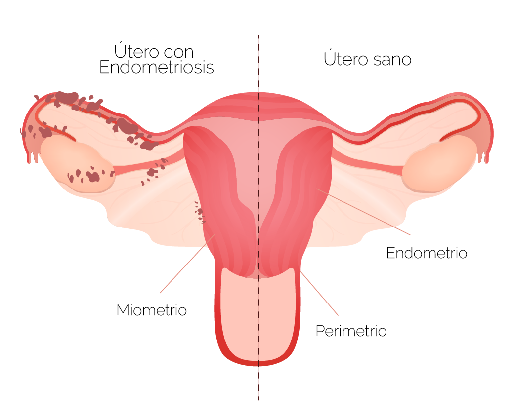 Endometriosis 0659