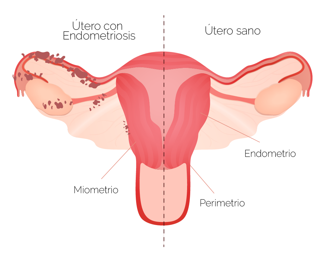 Endometriosis 5472